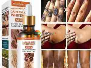 Get Rid Of Vitiligo And Tattoos In Cross City In Florida
