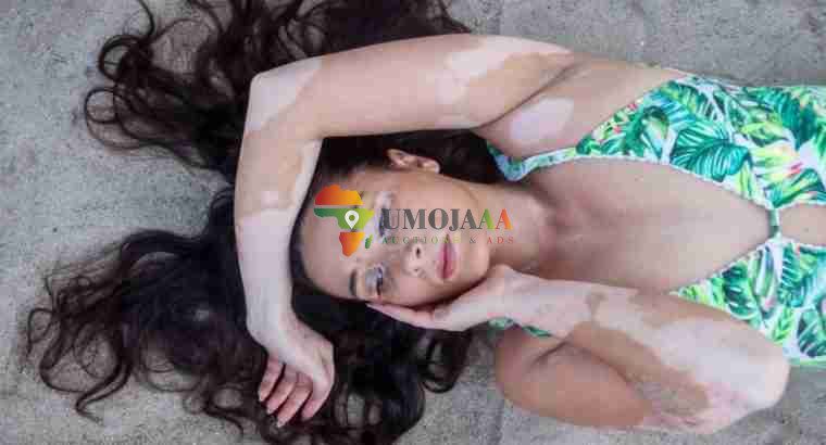 Get Rid Of Vitiligo And Tattoos In Cross City In Florida