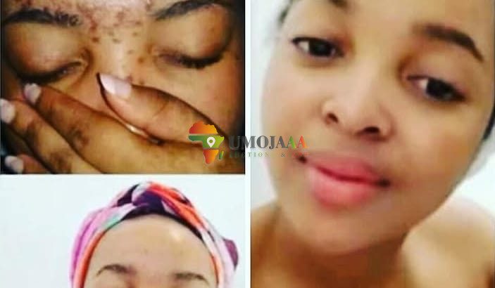 face cream for pimples and dark spots